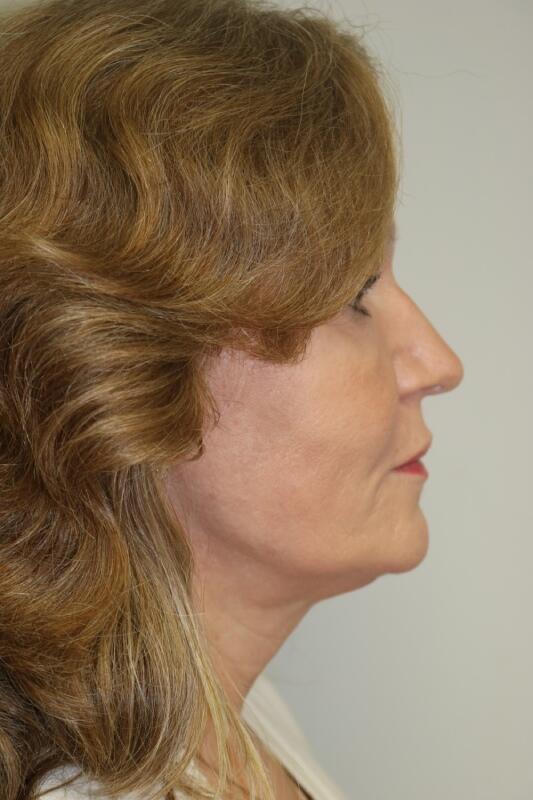 Facelift Before & After Image