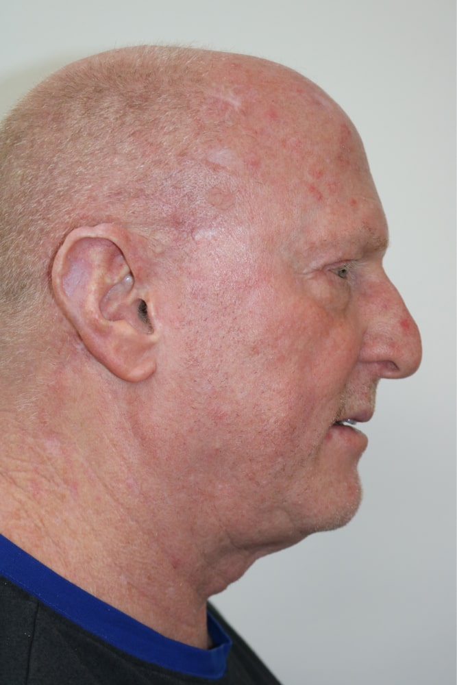 Facelift Before & After Image