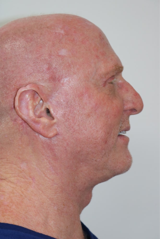 Facelift Before & After Image