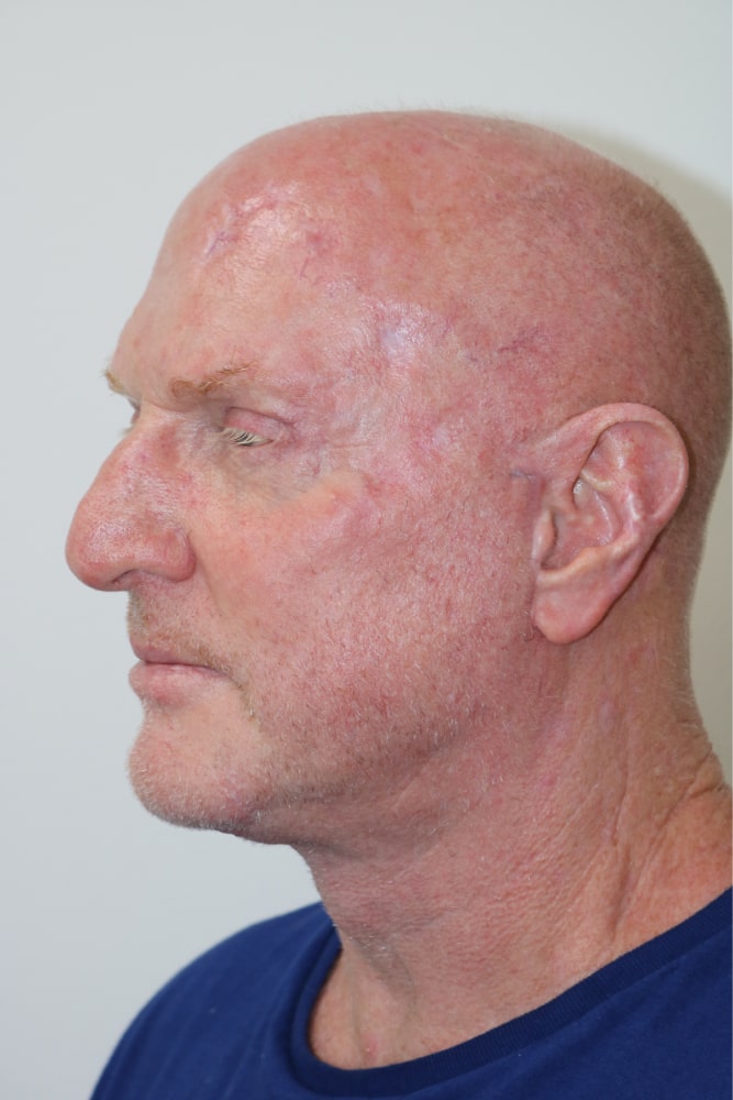 Facelift Before & After Image