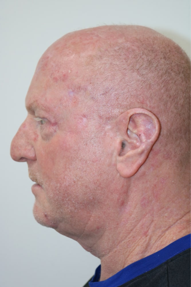 Facelift Before & After Image