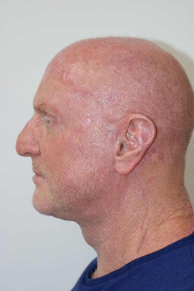 Facelift Before & After Image