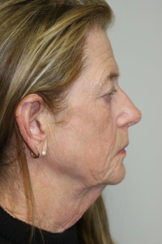 Facelift Before & After Image