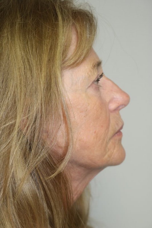 Facelift Before & After Image