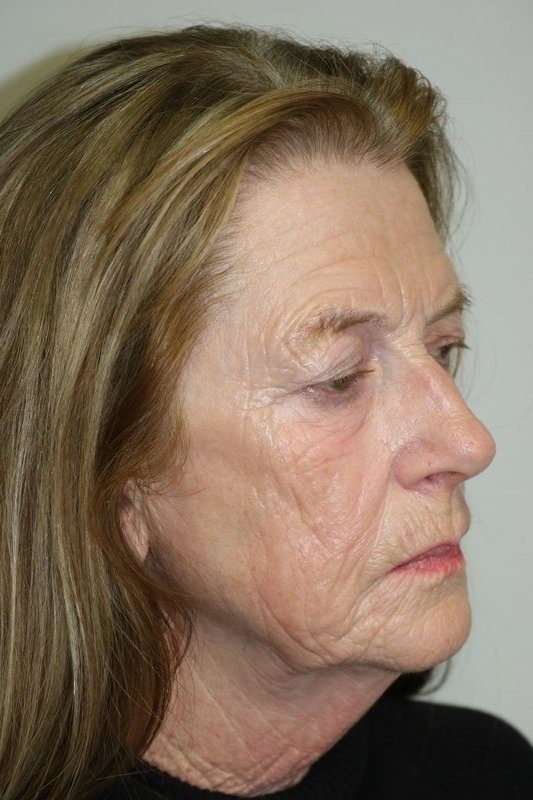 Facelift Before & After Image