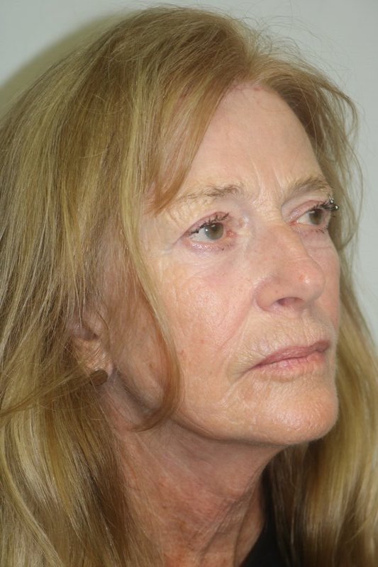 Facelift Before & After Image
