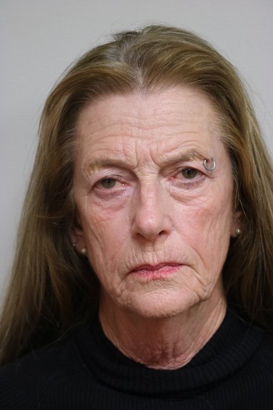 Facelift Before & After Image