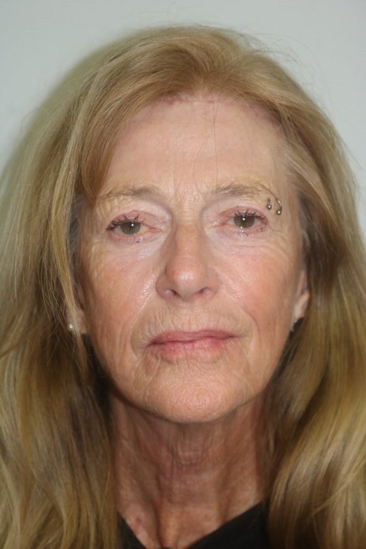 Facelift Before & After Image