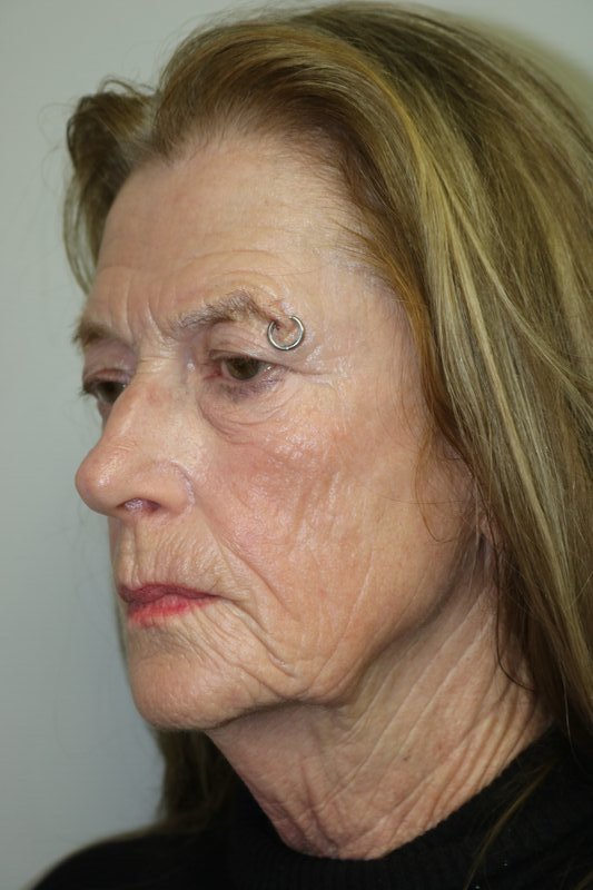Facelift Before & After Image