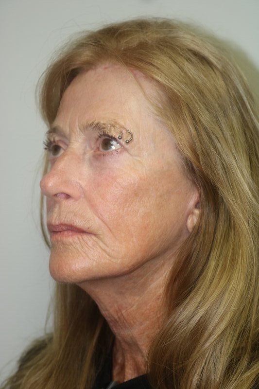 Facelift Before & After Image