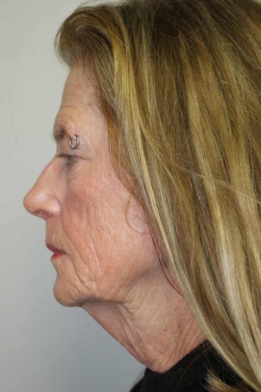 Facelift Before & After Image
