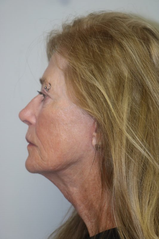 Facelift Before & After Image