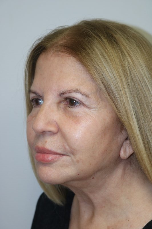 Facelift Before & After Image