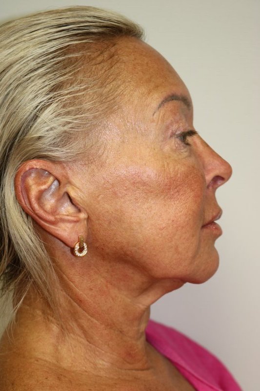 Facelift Before & After