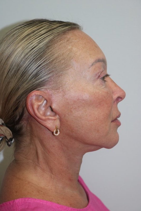 Facelift Before & After