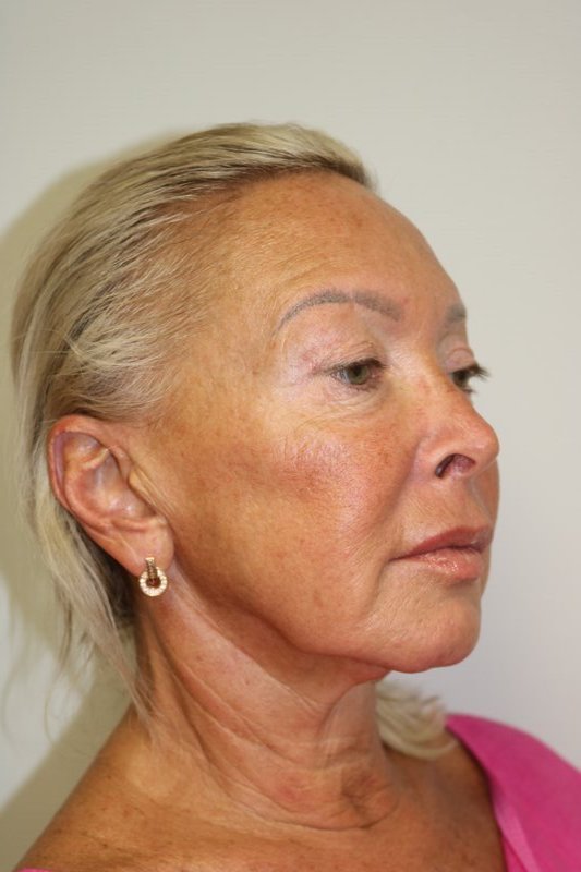 Facelift Before & After
