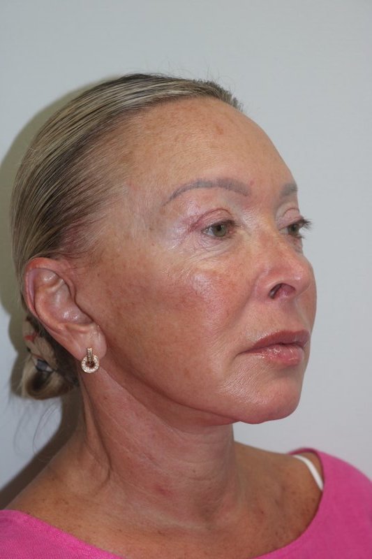 Facelift Before & After