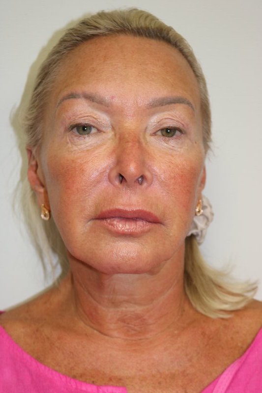 Facelift Before & After