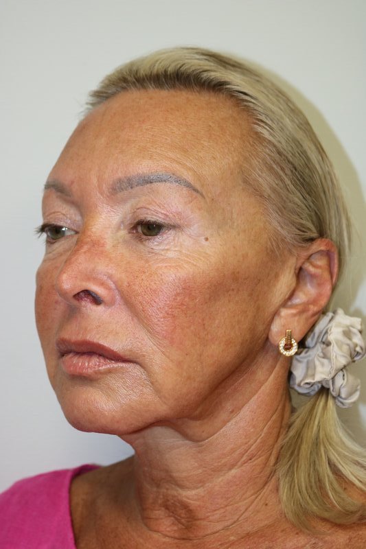 Facelift Before & After