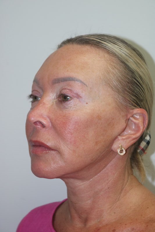 Facelift Before & After