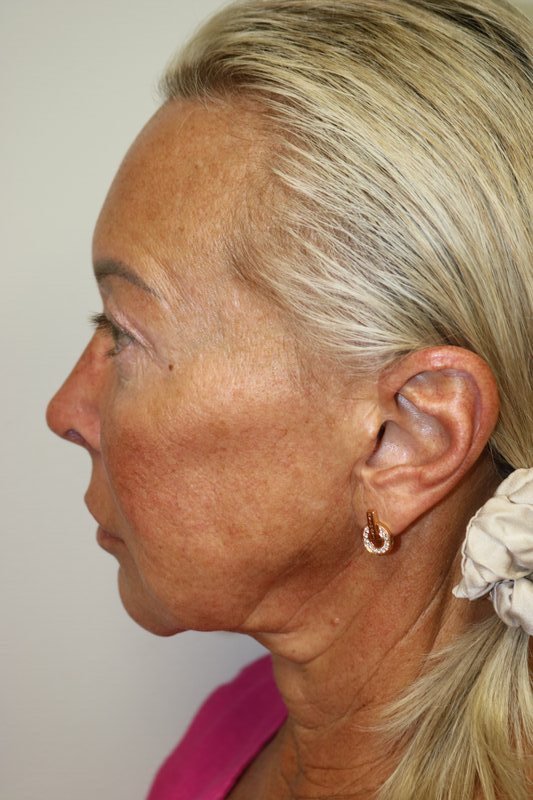 Facelift Before & After
