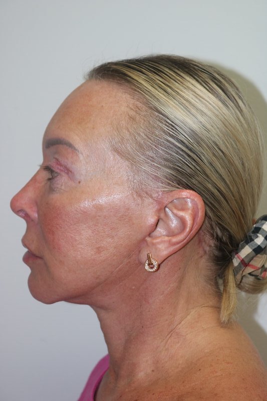 Facelift Before & After