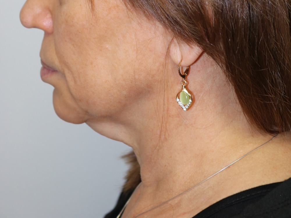 Facelift Before & After
