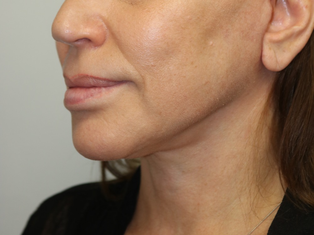 Facelift Before & After