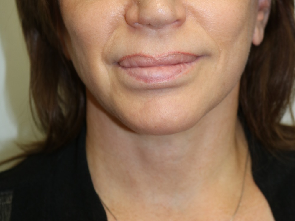 Facelift Before & After