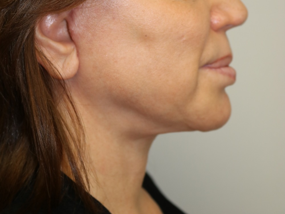 Facelift Before & After