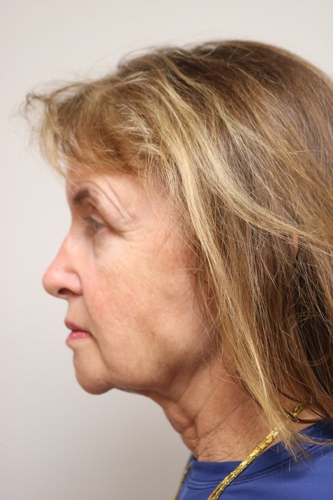 Facelift Before & After