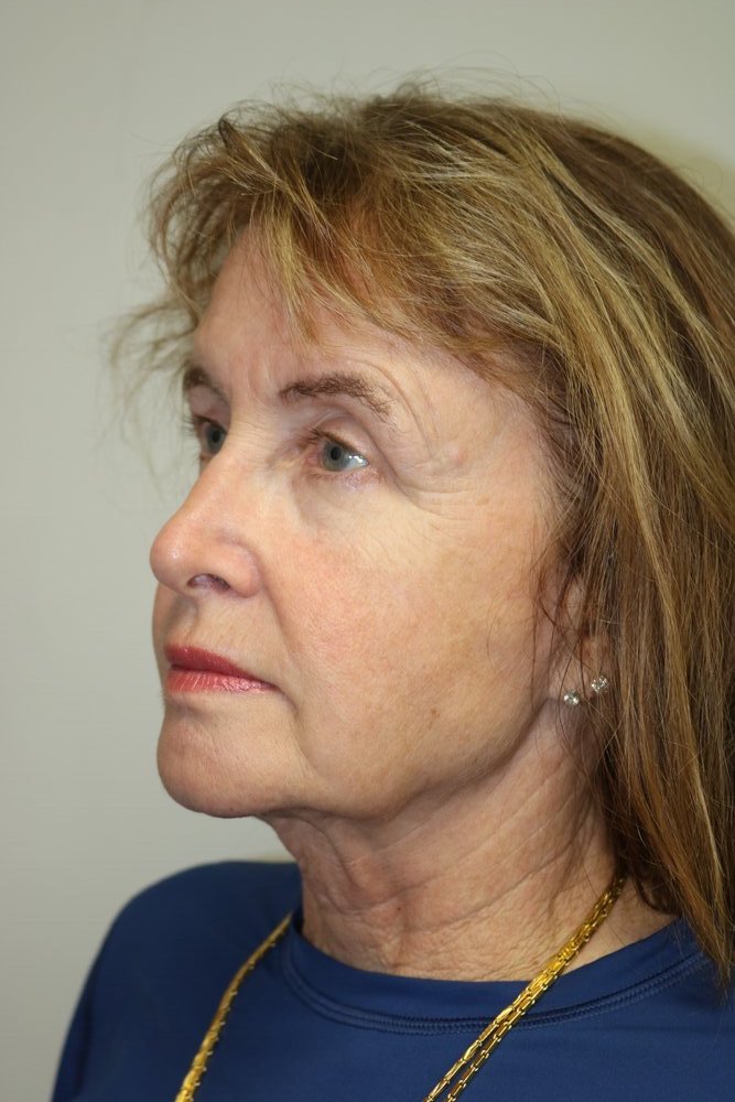 Facelift Before & After