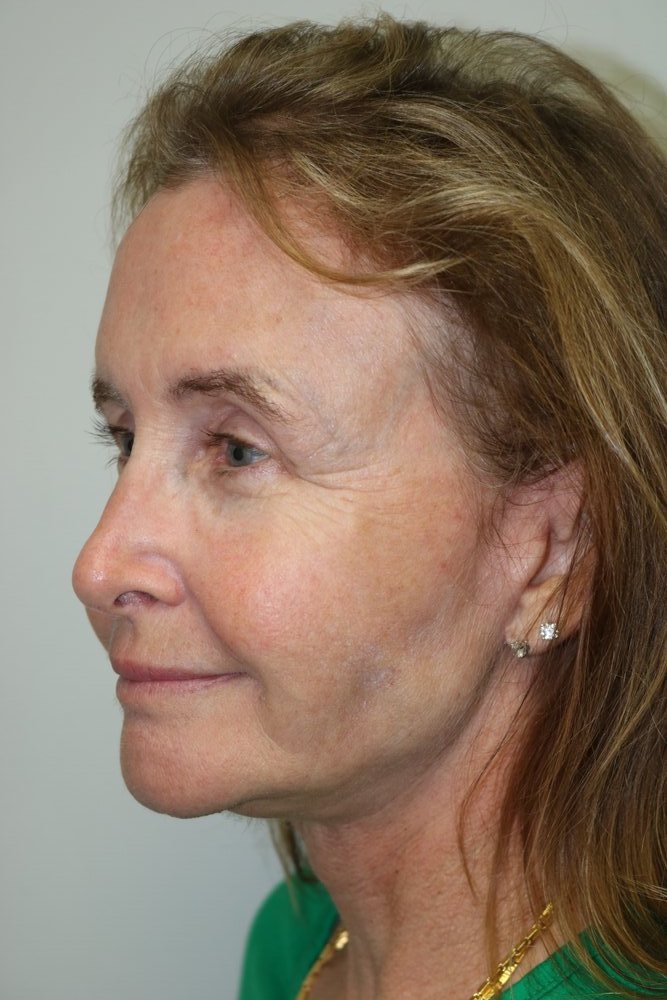 Facelift Before & After