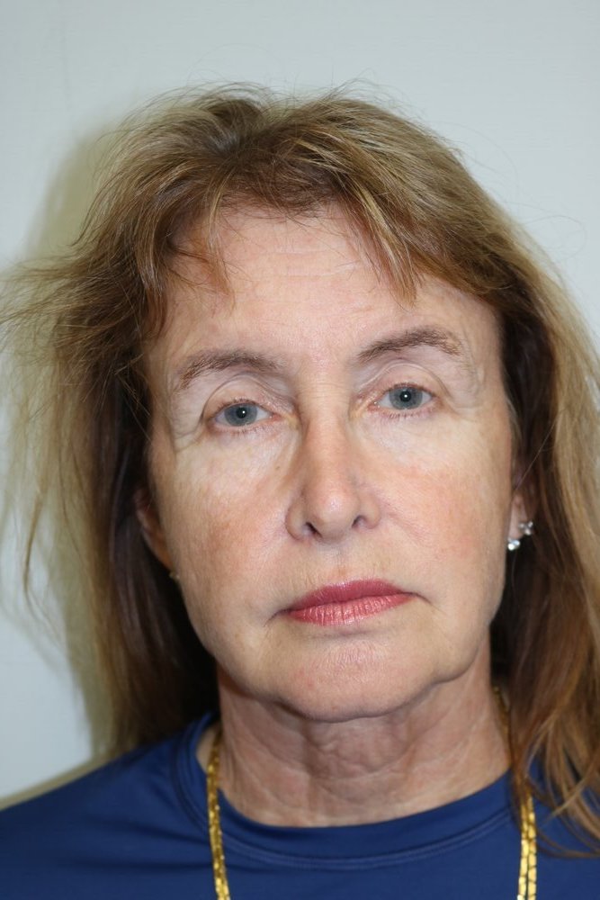 Facelift Before & After
