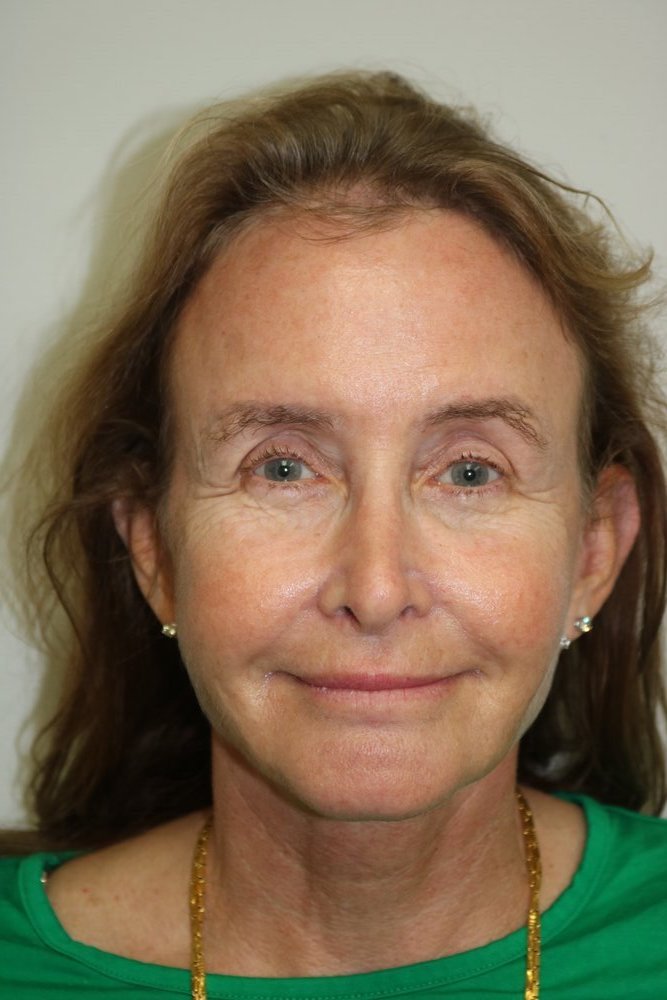Facelift Before & After