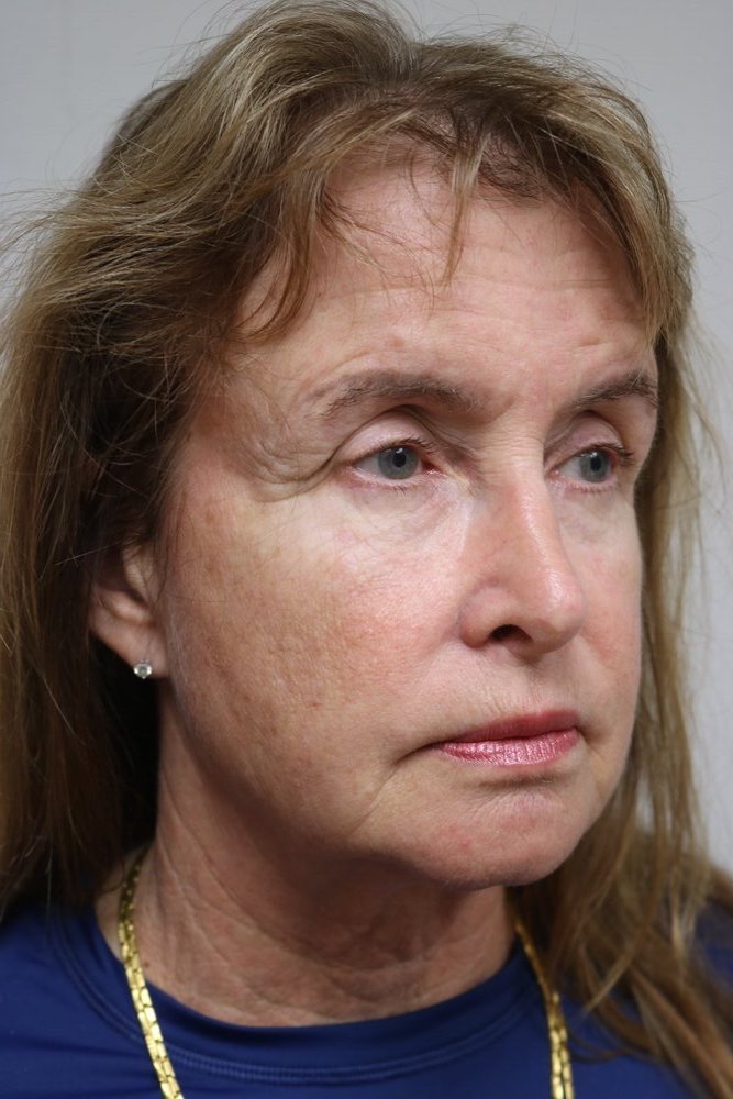 Facelift Before & After