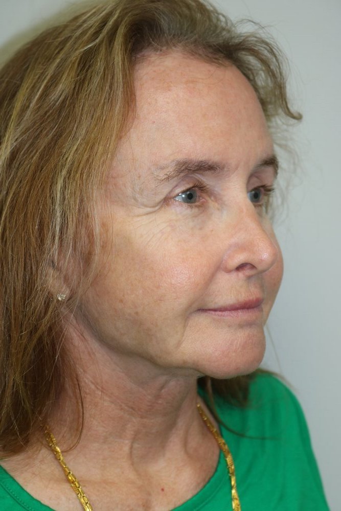 Facelift Before & After