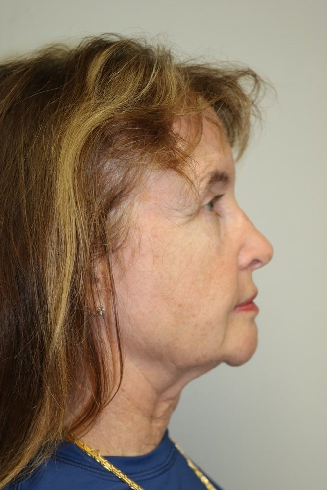 Facelift Before & After