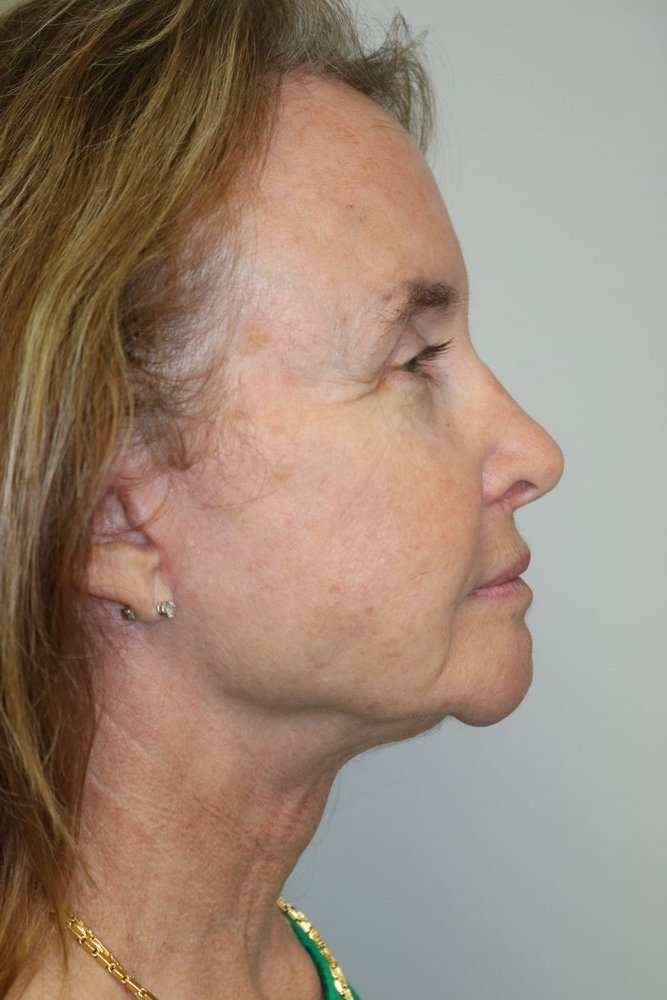 Facelift Before & After
