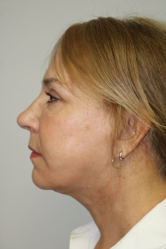 Facelift Before & After