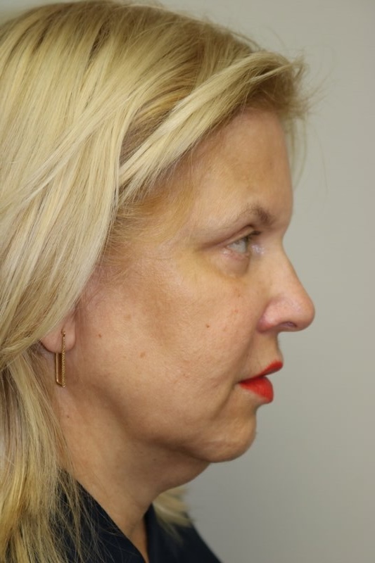 Facelift Before & After