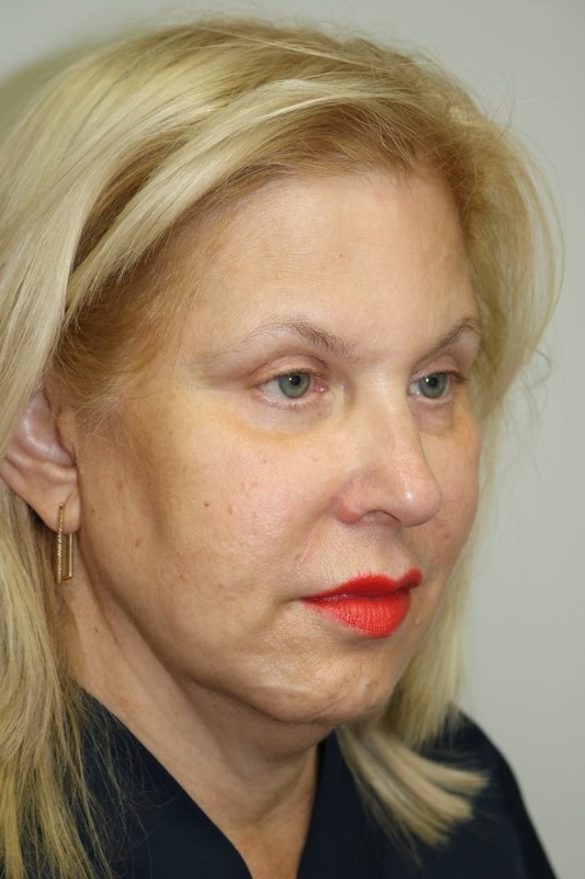 Facelift Before & After