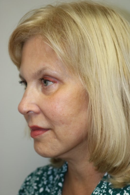 Facelift Before & After
