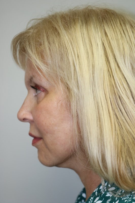 Facelift Before & After