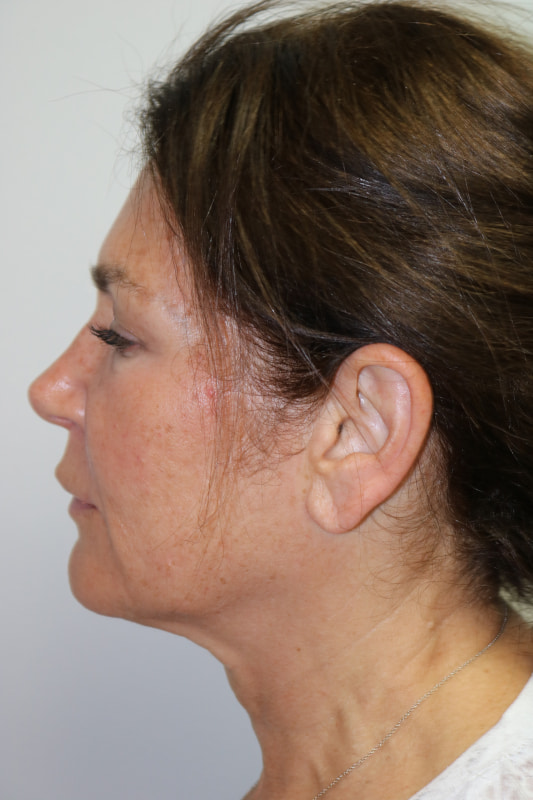 Facelift Before & After