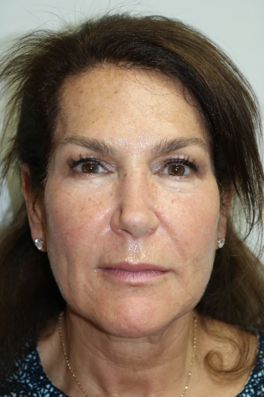Facelift Before & After