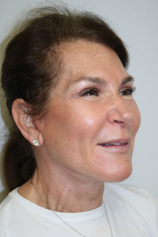 Facelift Before & After