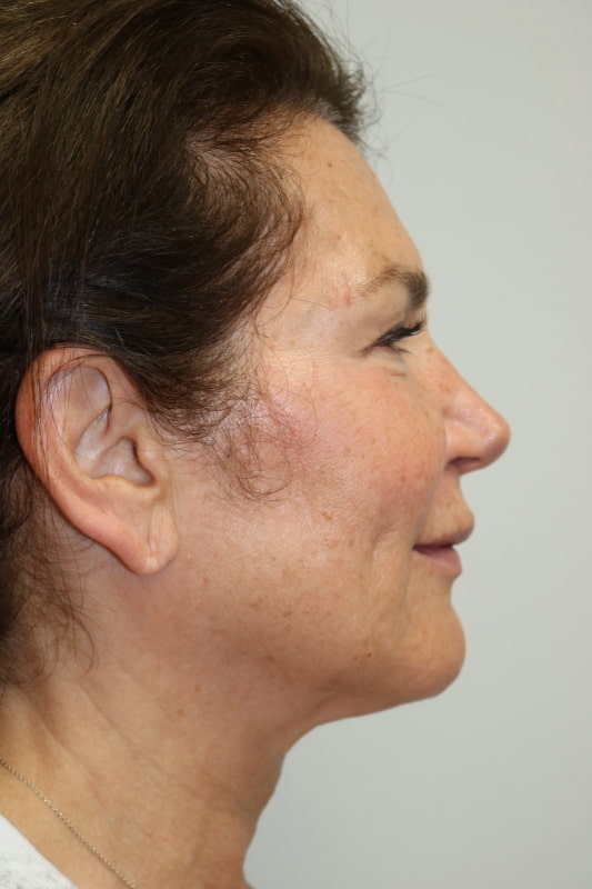 Facelift Before & After