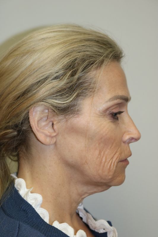 Facelift Before & After