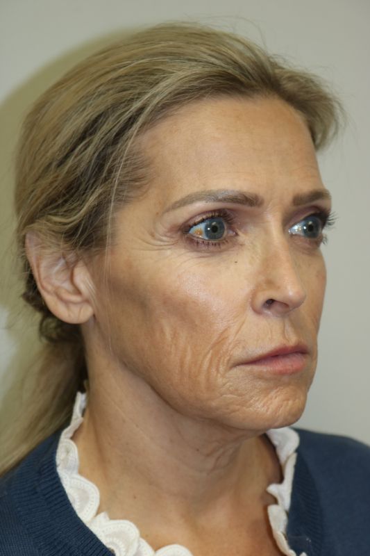 Facelift Before & After